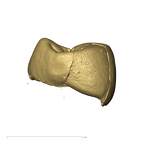TM1517c Paranthropus robustus LLP3 mesial