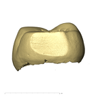 TM1517c Paranthropus robustus LLP4 distal