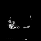 SKW 18 Paranthropus robustus partial cranium internal