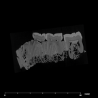 SK 1587a Paranthropus robustus partial mandible internal