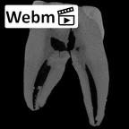 SK 17 Paranthropus robustus URM1 ct stack movie