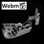 SK 63 Paranthropus robustus hemimandible left ct stack movie