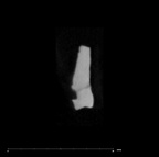 SK 80 Homo tooth fragment internal