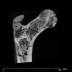 SK 82 Paranthropus robustus right femur proximal internal