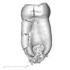 SK 846a Paranthropus robustus LRM1 mesial