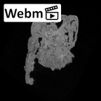 SK 872 Paranthropus robustus ULM1 ct stack movie