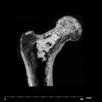 SK 97 Paranthropus robustus right femur proximal internal