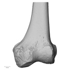 DV15-123 Homo sapiens femur left distal anterior