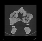 KNM-ER 1805 Homo habilis maxilla mandible medical ct ct slice