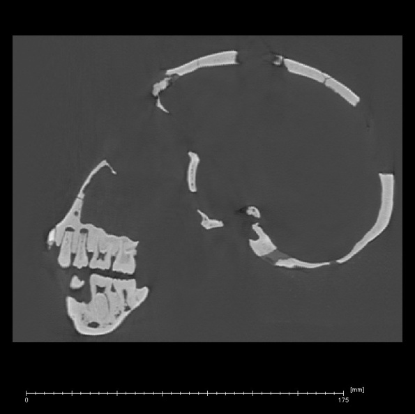 KNM-WT 15000 Homo erectus skull medical ct ct slice