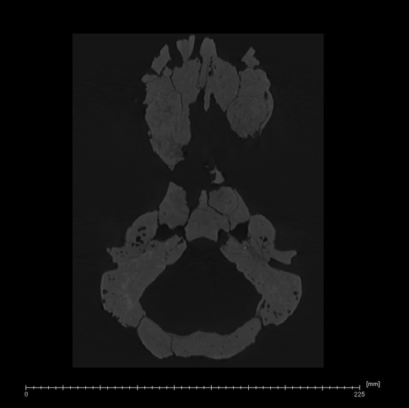 KNM-WT 17000 Paranthropus aethiopicus cranium medical ct ct slice