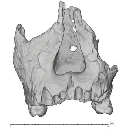 KNM-WT 62000 Homo rudolfensis maxilla medical ct anterior