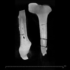 KNM-ER 1481A Homo habilis left femur ct slice