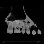 KNM-WT 15000A Homo erectus maxilla ct slice