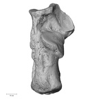 calcaneus left
