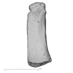 metacarpal first right