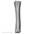 metacarpal third right metaphysis