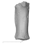 metacarpal first right