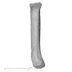 metacarpal fifth right