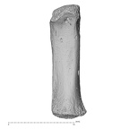 metacarpal first right