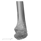 radius right distal