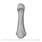 metacarpal first right