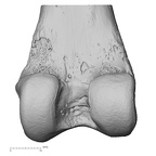 femur left distal