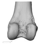 femur right distal