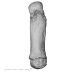 metacarpal first left