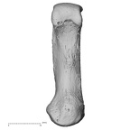 metacarpal first left