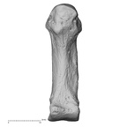 metacarpal first right