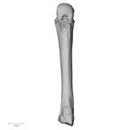 metacarpal fourth right