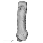 metacarpal first left
