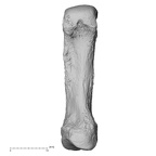 metacarpal first left