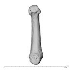 metacarpal first left