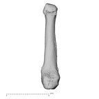 metacarpal first right
