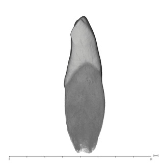 UW101-1005B Homo naledi LRI1 distal