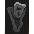 UW101-1142 Homo naledi hide osteoma 1