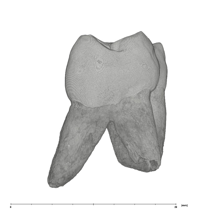 UW101-708 Homo naledi ULM1 distal