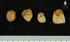 STW 75-79 Australopithecus africanus associated upper dentition 1